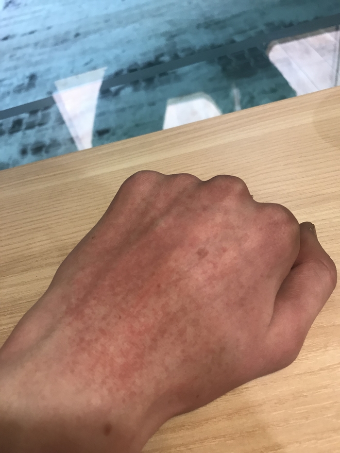 Руку высыпает от холода
