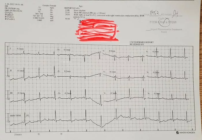 Help decipher the cardiogram - My, Cardiology, The medicine, Doctors need help, ECG