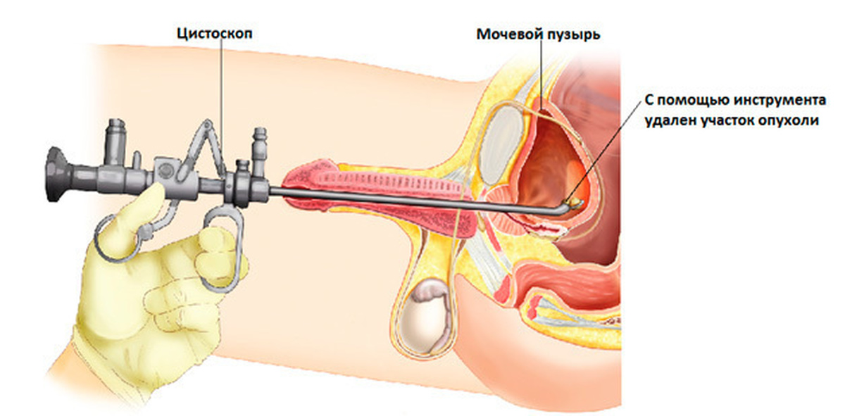 Цистоскопия это. Инстилляция мочевого пузыря. Инстилляция уретры у мужчин.