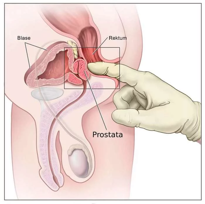 How prostate massage is performed - My, Prostate, Massage, Men's Business, Men, Guys, Treatment, Undercooling, Advice, Useful, Prostatitis, Guys will understand, Male, Urology, Proctology, Urologist, Proctologist, Longpost