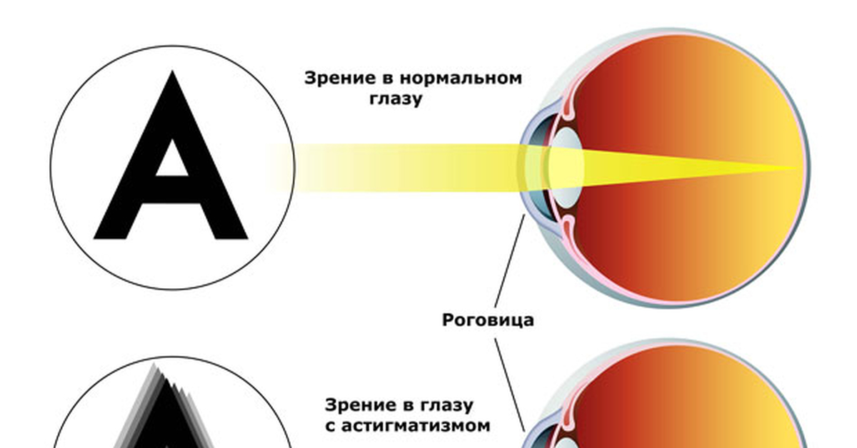 Астигматизм Лечение У Взрослых Лазером Цена