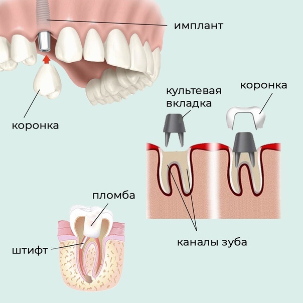 № 17. Implant or bridge - which is better? - My, Dentistry, Longpost, Dental implantation