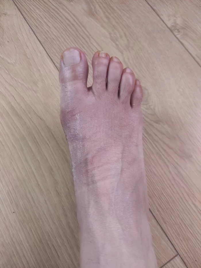 Answer to the post Clinic for dummies ~ (PIKABOO POWER! WITHOUT RATING) - My, No rating, The strength of the Peekaboo, Health, Free medicine, The medicine, Doctors, Treatment, Operation, Longpost, Reply to post, Hallux valgus, Gratitude