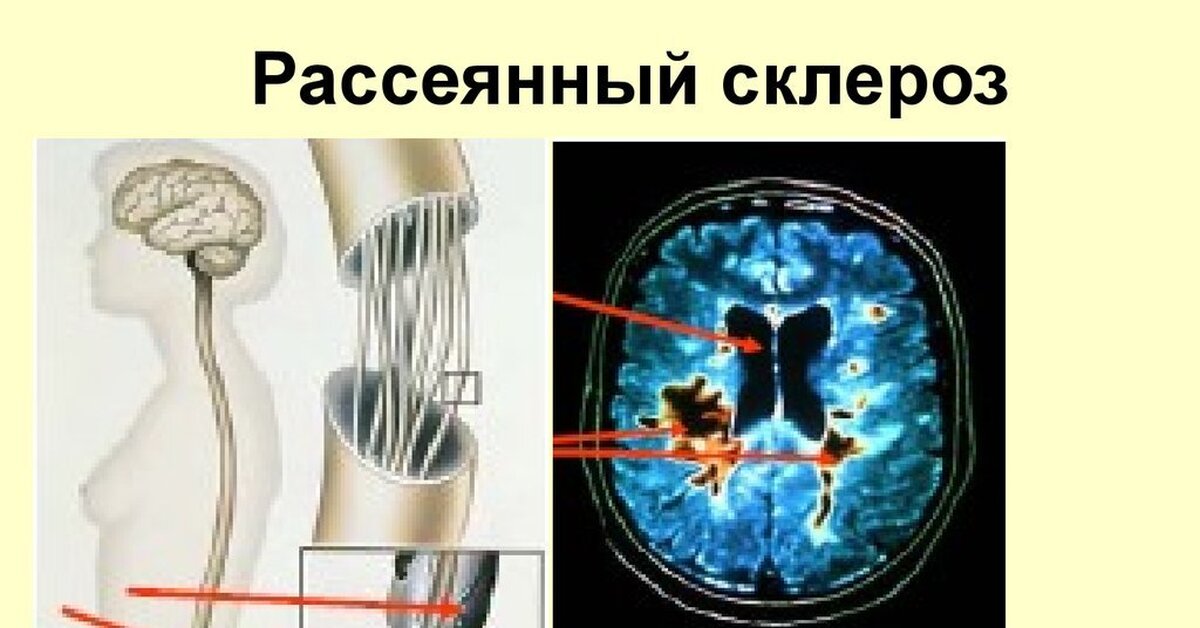 Рассеянный склероз что это. Рассеянный склероз. Растерянный склероз. Рассеивающий склероз. Рассеянный склероз презентация.