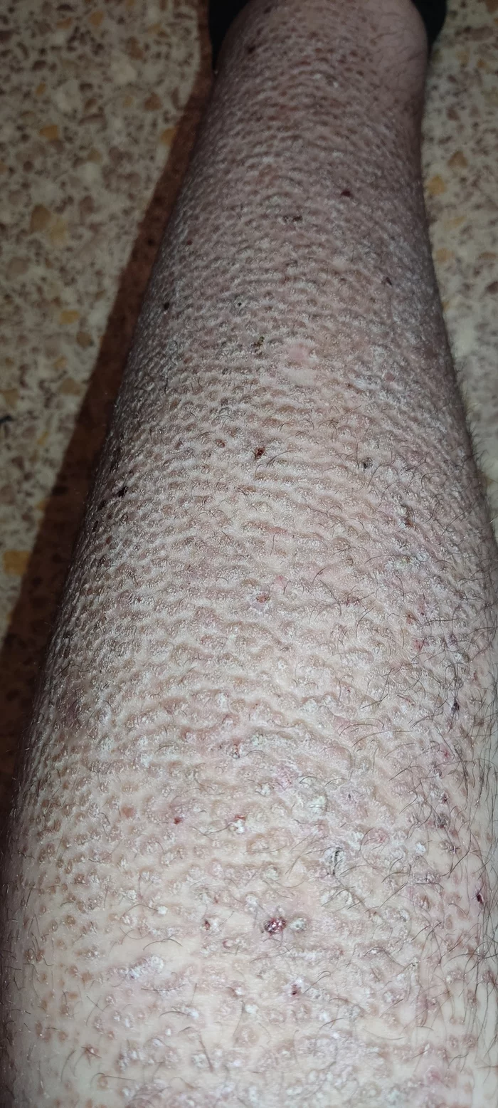 Disease. Need dermatologist advice - My, Dermatology, Problem skin, No rating, Longpost