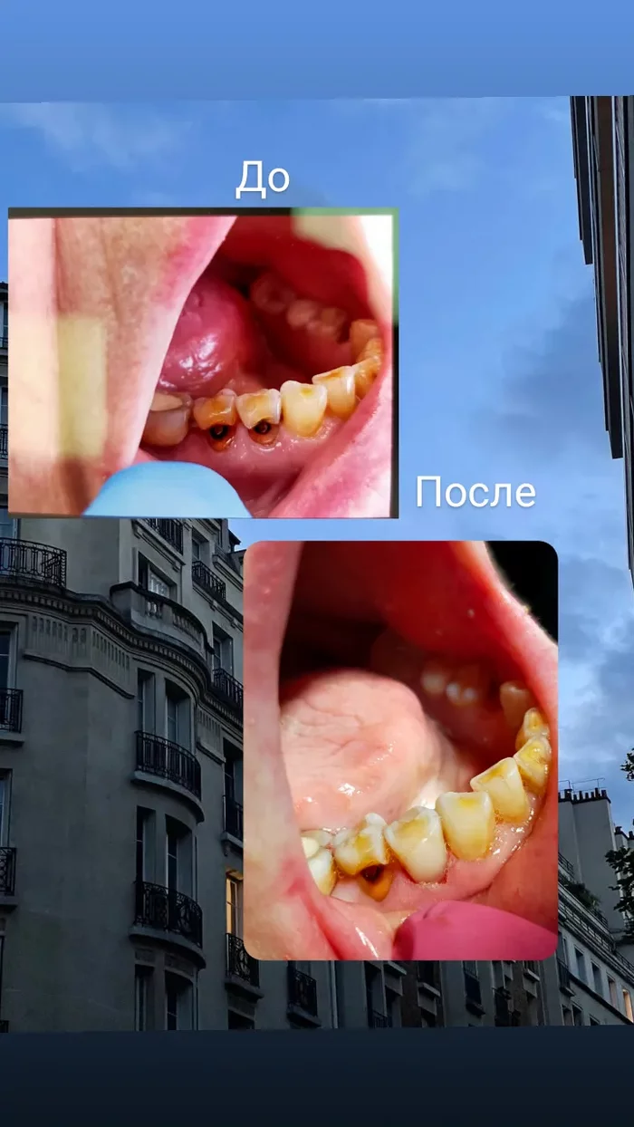 Стоматология бесплатно - Моё, Медицина, Стоматология, Длиннопост, Добровспышка, Без рейтинга, 