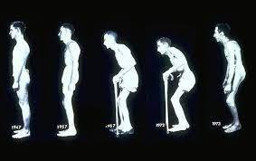 Ankylosing spondylitis. Large analysis - My, Rheumatology, Rheumatologist, Health, The medicine, Medications, Longpost, Ankylosing spondylitis, 