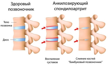 Анкилозирующий спондилит. Большой разбор - Моё, Ревматология, Ревматолог, Здоровье, Медицина, Лекарства, Длиннопост, Анкилозирующий спондилит, 