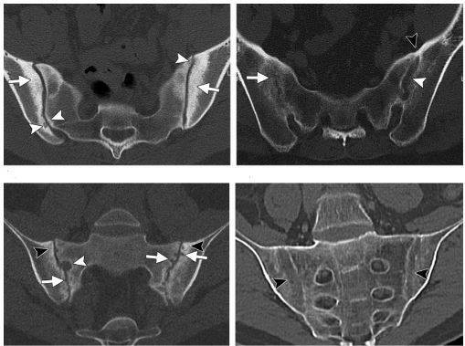 Ankylosing spondylitis. Large analysis - My, Rheumatology, Rheumatologist, Health, The medicine, Medications, Longpost, Ankylosing spondylitis, 