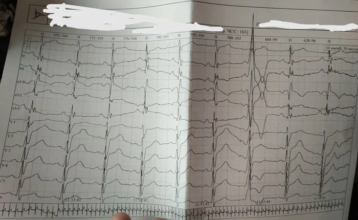 Прошу помощи кардиологов пикабу - Без рейтинга, Помощь, Кардиология, Нужна помощь врачей, Здоровье, Сердце, Кардиограмма, 