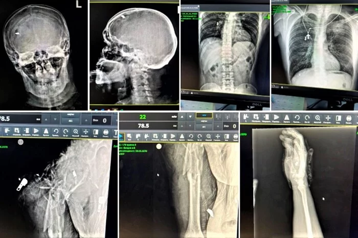 Записки киевского врача. Как справиться с разными типами ранений - Моё, Хирургия, Ранение, Операция, Ретнген, Длиннопост, 