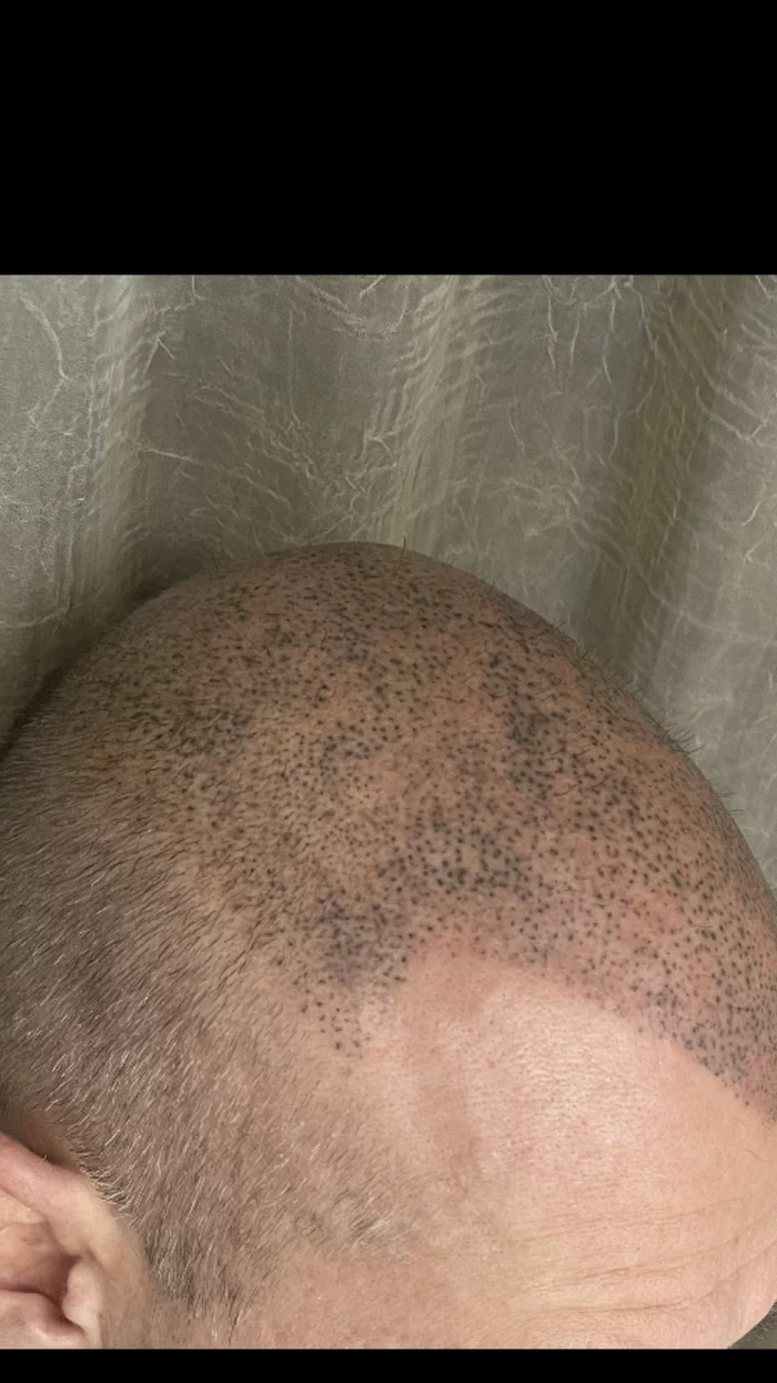 Masking a bald head by a crooked master - My, Bald head, Trichopigmentation, Longpost, 