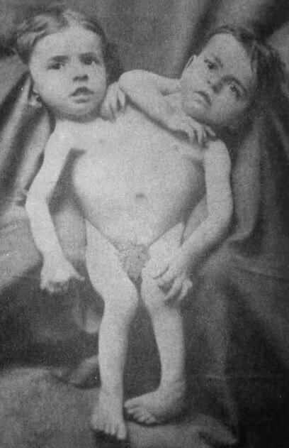 Siamese twins Giacomo and Giovanni Tocci. The Italian analogue of the Krivoshlyapov sisters - Horror, Tragedy, CreepyStory, Siamese twins, Italy, Story, Longpost