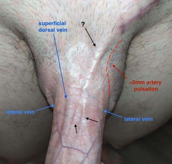 Varicocele, complications after surgery - My, Varicocele, Hernia, Circumcision, Complication, The medicine, Urology, Longpost