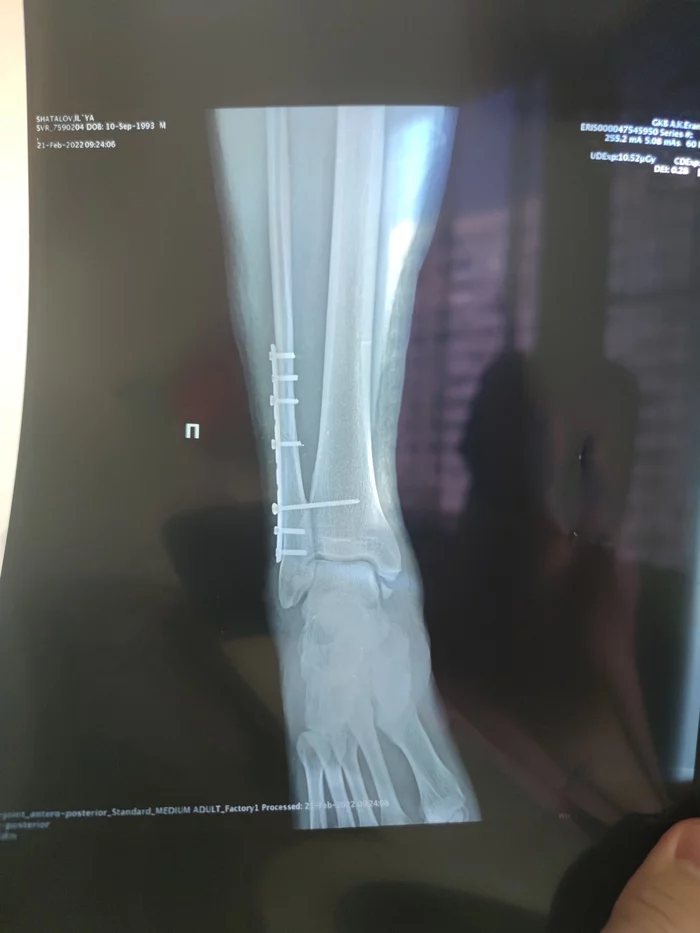 Help with advice: orthosis and insurance - Need advice, No rating, Longpost, Help, Страховка, The medicine, Bondage, Orthez, Fracture, Broken leg, My