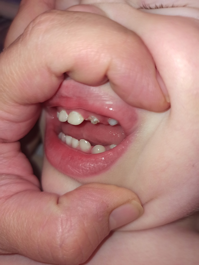 Помогите советом, детские стоматологи