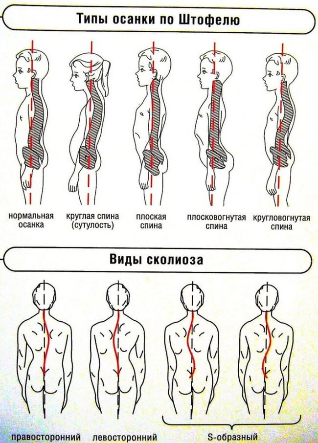 The body speaks to us. Spine.  Bearing.  Spinal cord. (from the series Healthy Delirium) - My, Spine, Posture, Scoliosis, Diagnostics, Health, Longpost, 