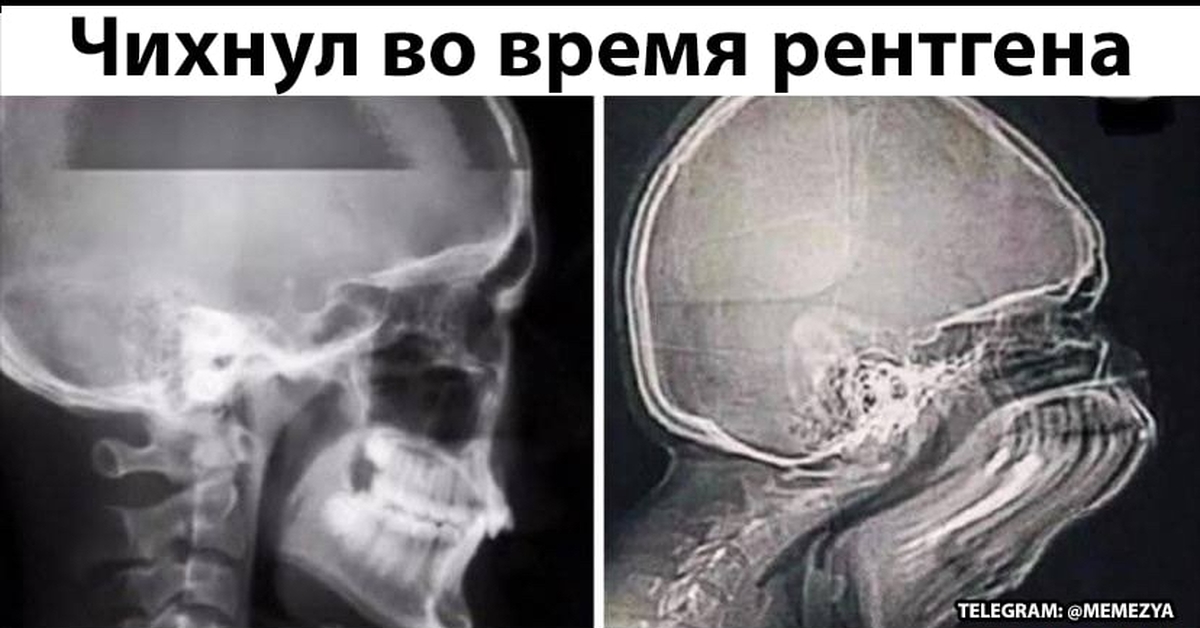 Рентген время. Человек чихнул на рентгене. Чихнул во время рентгена. Череп чихнувшего человека.