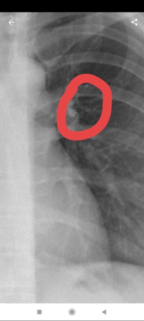 Tubik - Fluorography, Tuberculosis