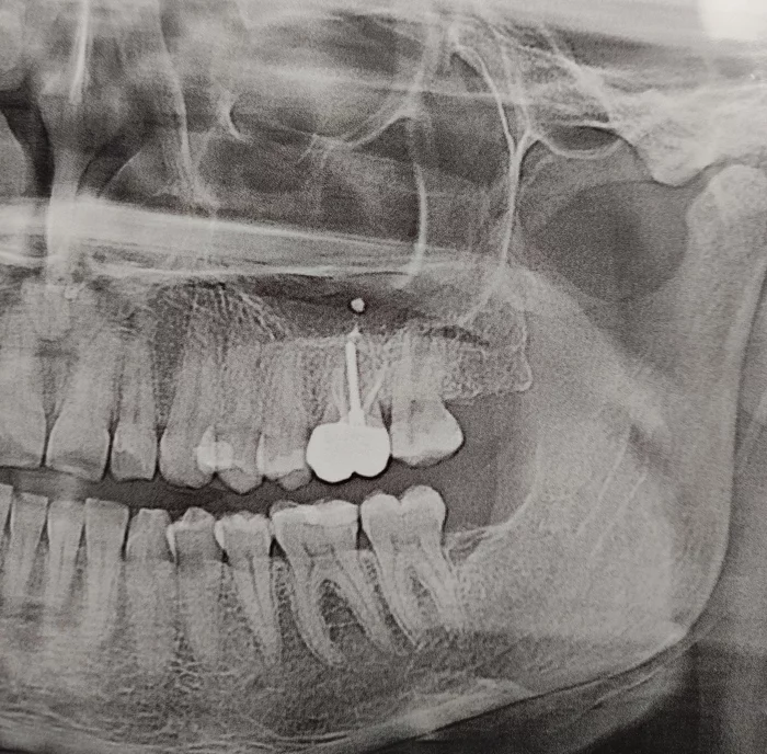 White dot in a panoramic picture of the teeth. What is this? - The medicine, Dentistry, Question, Problem