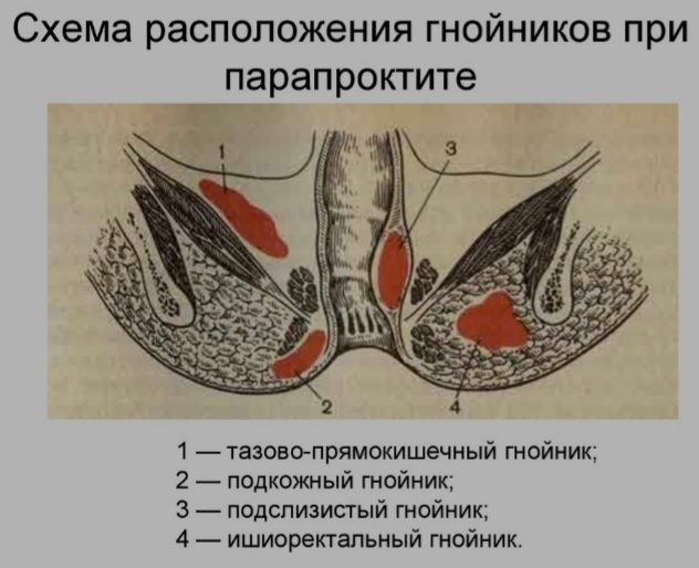 Всё, что вы хотели узнать, но стеснялись спросить о проблемах в тылу. Часть 1: анатомия и патология - Моё, Медицина, Здоровье, Проктология, Геморрой, Длиннопост