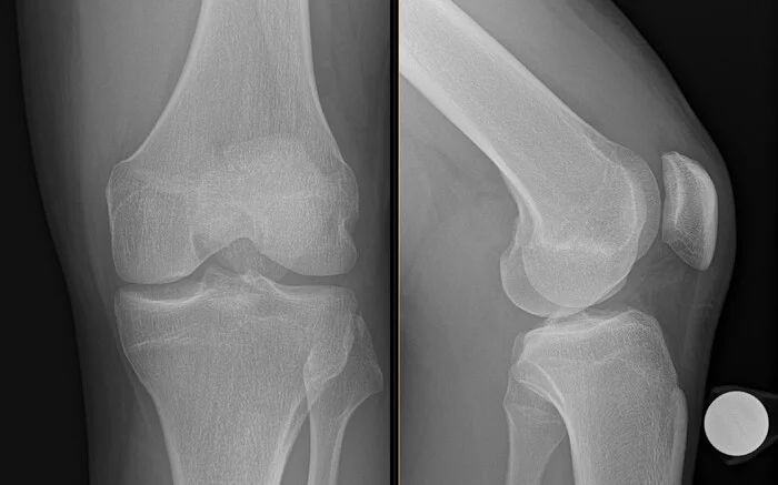 Случай из практики. Травма коленного сустава. Рентген с сюрпризом: разрыв ПКС - Моё, Личный опыт, МРТ, Суставы, Рентгенология, Радиология, Травма, Длиннопост