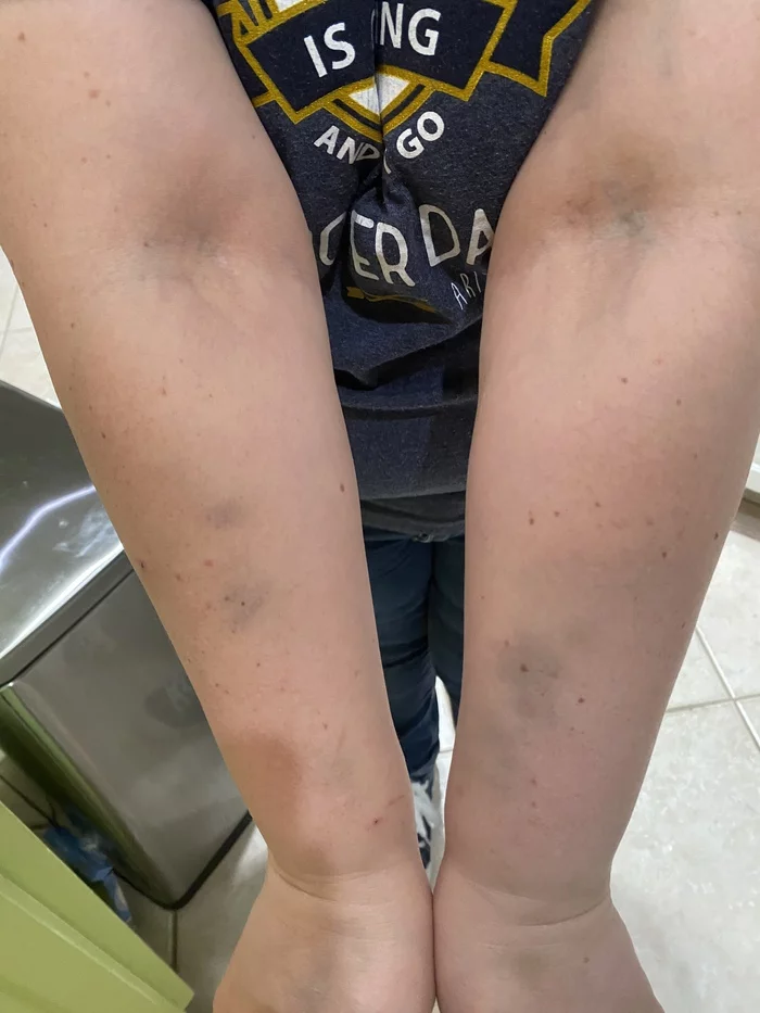 Improper self-defense - Self defense, Bruise, Mat, Longpost