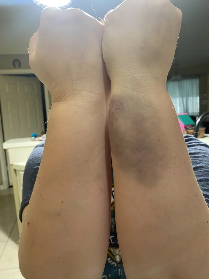 Improper self-defense - Self defense, Bruise, Mat, Longpost