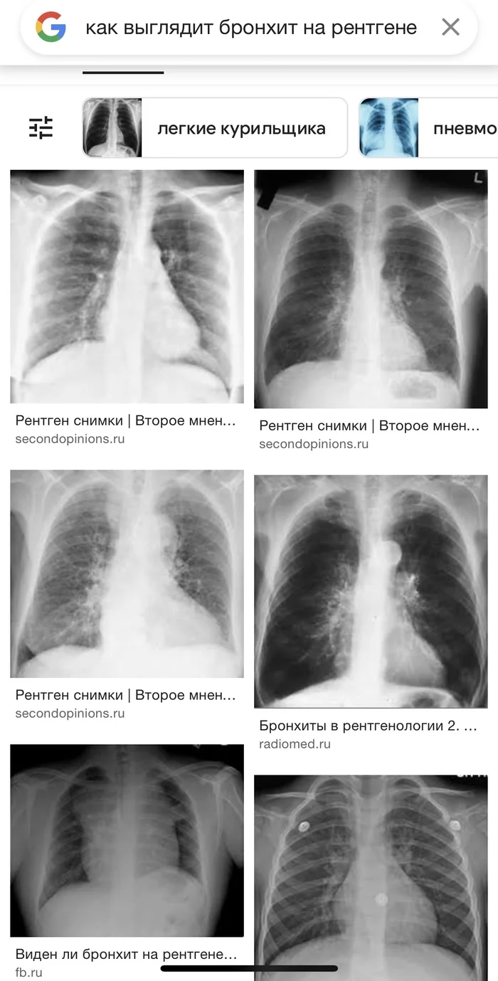 What does bronchitis look like on an X-ray - Bronchitis, Bronchi, Inflammation, X-ray, The photo