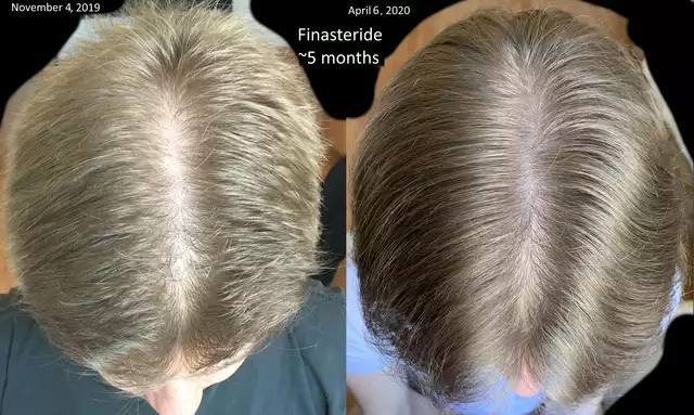 How I Defeated Baldness | What to do with male pattern baldness | Hair loss - My, Baldness, Hair, Treatment, Hair Transplant, Video, Youtube, Longpost