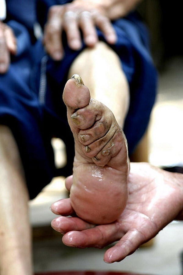 47 shocking pictures of Chinese 'lotus women' feet - Informative, Ugliness, Around the world, Longpost