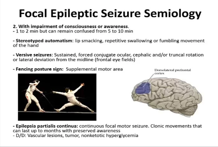 Припадок эпилепсии - поза фехтовальщика - Эпилепсия, Фехтование, Болезнь, Судороги, Дети, ДЦП, Спорт, Видео, YouTube, Длиннопост