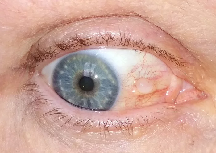 Eyes - need medical advice! - My, No rating, The medicine, Consultation, Doctors need help, Help, Ophthalmology, Eyes, Disease, Injury, Need advice, Need your opinion, What to do