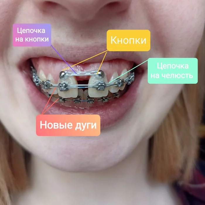 Life and hole. - My, Dylk, Bite, Bite correction, Malocclusion, Distal bite, Teeth, Braces, Dentistry, Jaws, Orthodontics, Longpost