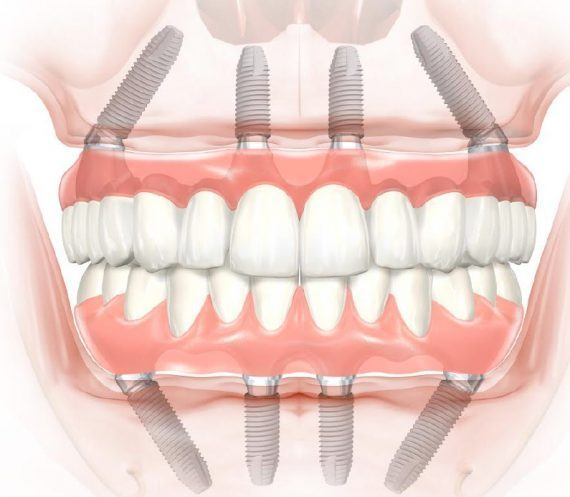 [Advice needed] All-in-4 implantation, is the doctor right? Are fears pointless? - My, Teeth, Dentistry, Implants, Treatment, Operation, Text