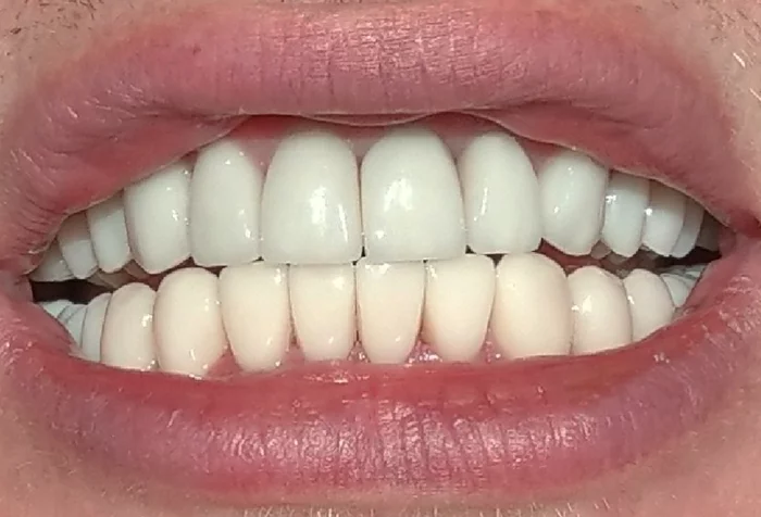 Dentist put veneers in different colors - My, Dentist, Veneers, Different color, Need advice, Legal aid, League of Lawyers, Dentistry, The photo