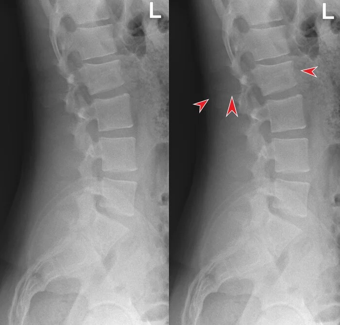 Из практики: перелом Шанса (Chance fracture) - Моё, Личный опыт, Перелом позвоночника, Рентген, Кт, Рентгенология, Радиология, История болезни, Видео, Без звука, Длиннопост