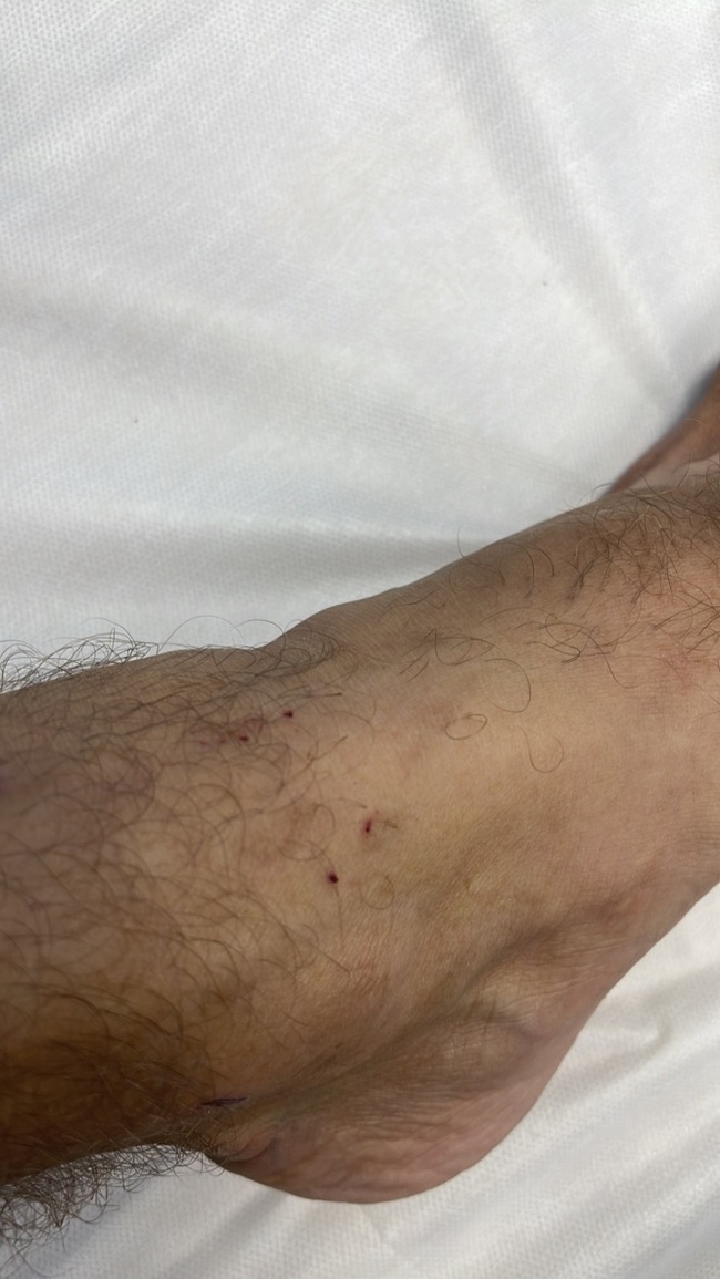 Snake bite. How it works. My experience - My, Snake bite, I, Hospital, Longpost