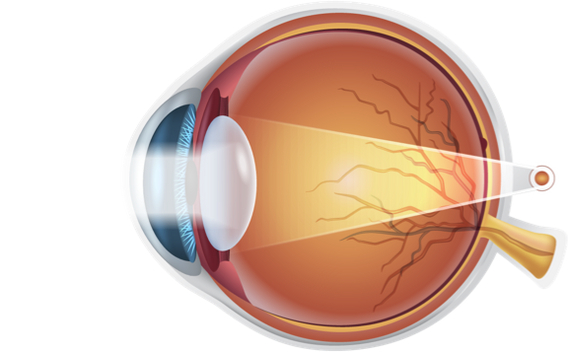 Presbyopia or age-related farsightedness, in non-medical terms - Health, The medicine, Ophthalmology, Longpost