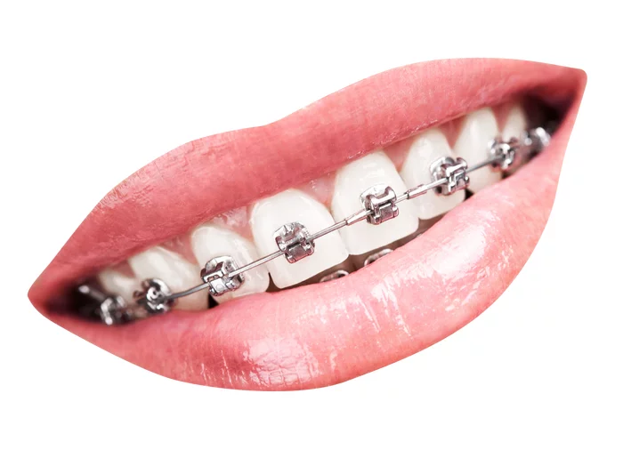 Braces. - My, Treatment, Nutrition, Health, Diet, Braces, Dentist