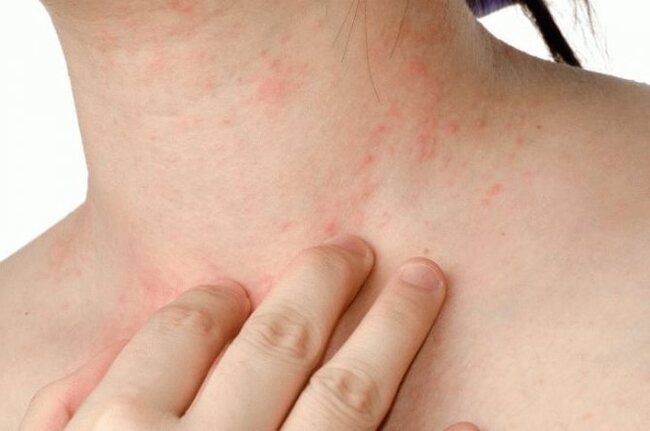 Red spots, hives, rashes, allergies on the body when losing weight, a common problem about which for some reason they write little on the Internet (there is a solution) - My, Slimming, Allergy, Rash, Red spots, Rubella, Hives