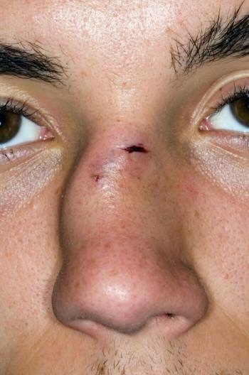 Broken nose - how to choose glasses? - Glasses, Injury, Question, Experience