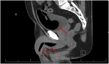 Polyurethane foam in the urethra as a method of treatment of erectile dysfunction - The medicine, Disease history, Repeat, Idiocy, Urethra, Erection