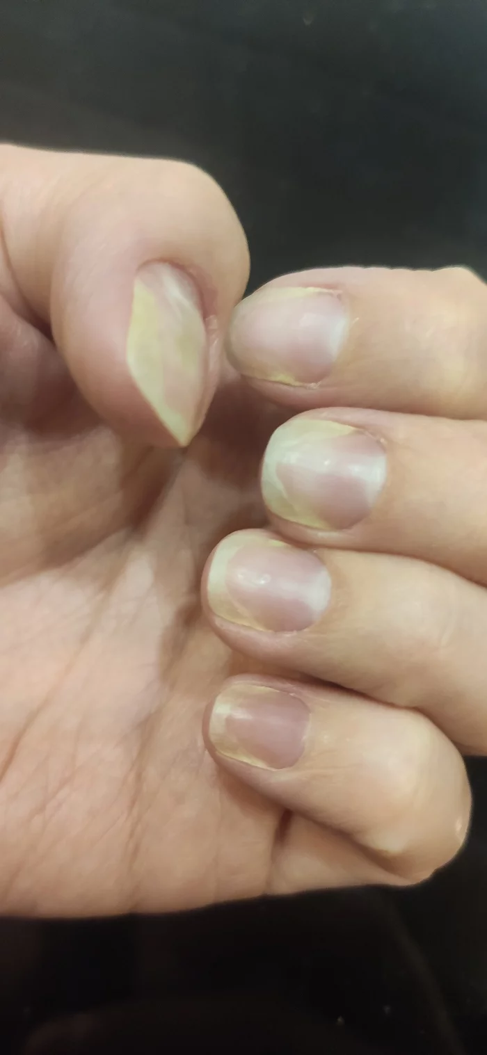 Unrated, please help! How is onycholysis treated? What to do? Nails peel off and turn yellow. Analyzes are all normal, not a fungus - My, No rating, Nails, Treatment, Longpost, Need advice, Dermatology
