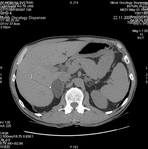 Pheochromocytoma or crisis, after which you will receive up to 5 liters of urine - My, The medicine, Disease, Operation, Cancer and oncology, Treatment, Longpost, Pheochromocytoma