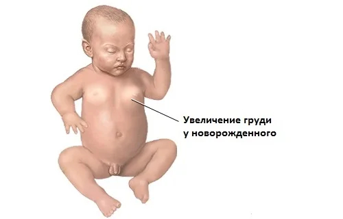 Transient states in the neonatal period - My, Children, The medicine, Pediatrics, Longpost