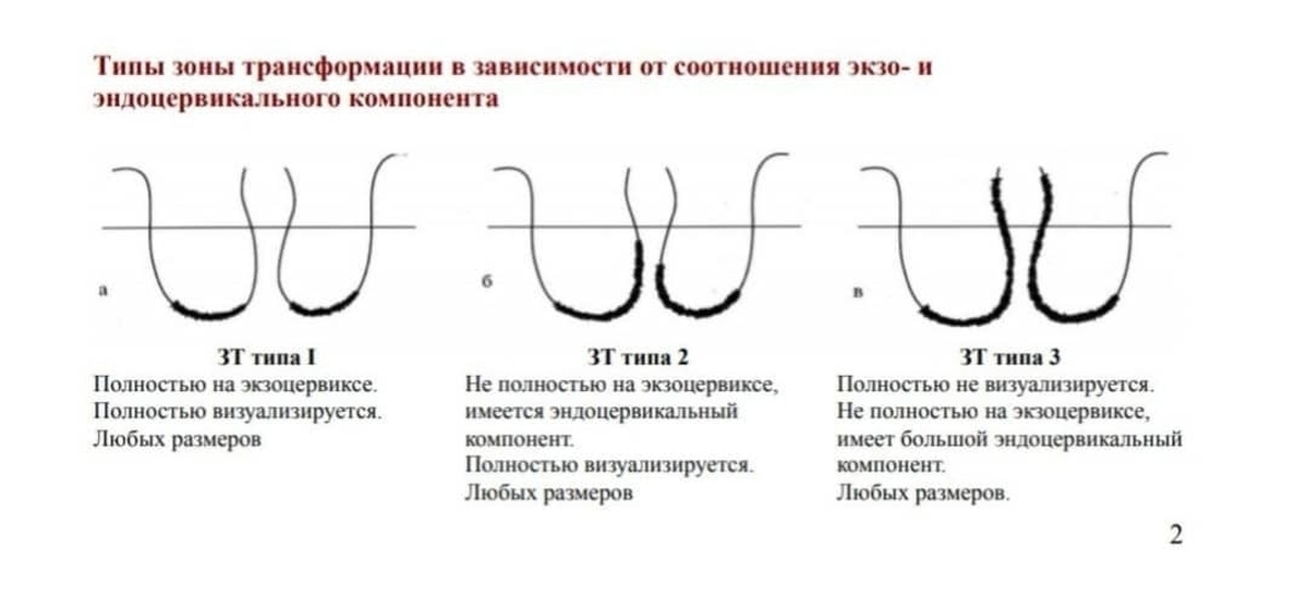 Аномальная кольпоскопическая картина 1 степени зт 3 типа что это