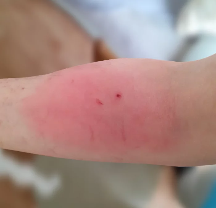 Bitten by a cat - My, cat, Bite, Disease history