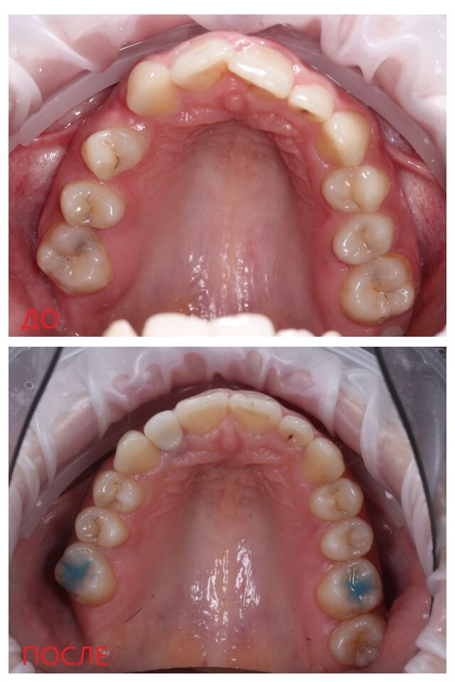 2.5 years of wearing braces - My, Braces, Result, It Was-It Was, Dentistry, Teeth, Implants, Longpost