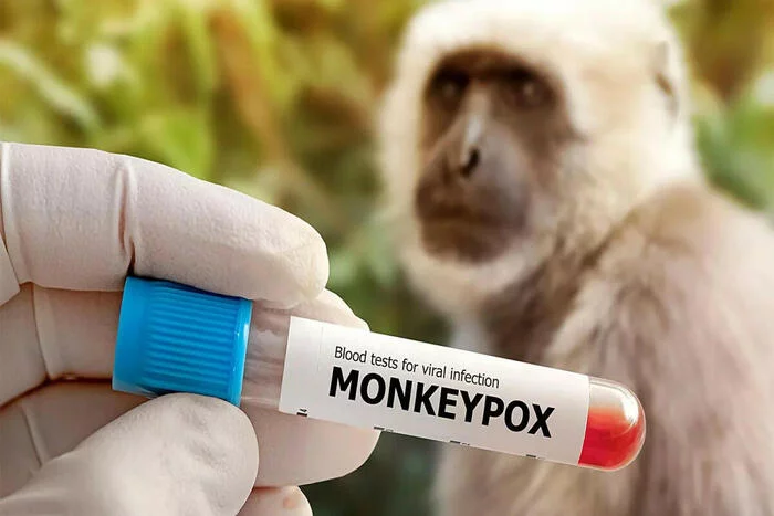 US declares monkeypox a national emergency - Monkeypox, Epidemic, Virus, USA, news, Smallpox